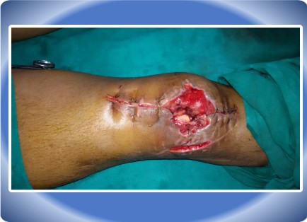 LOWER LIMB INJURY